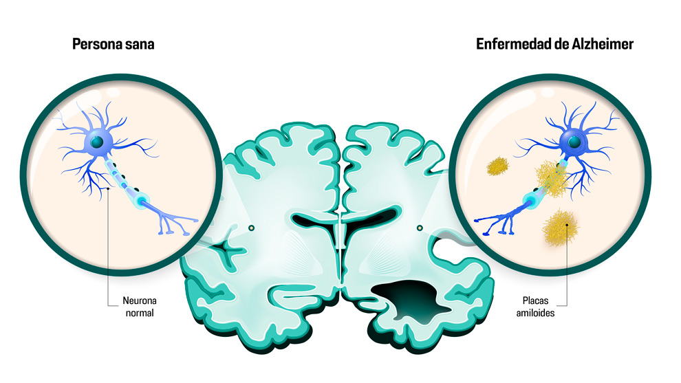 La enfermedad de Alzheimer tiene síntomas despúes de 15 o 20 años de daño celular a nivel molecular