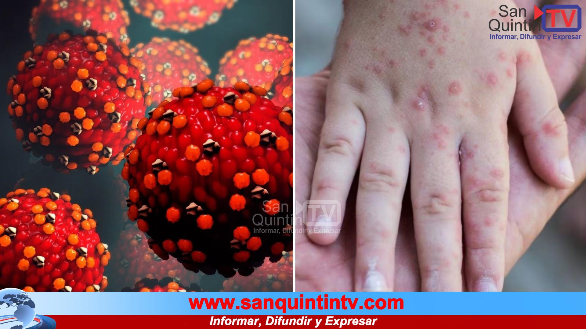 Alarma sanitaria: México registra más de 4 mil casos de sarampión y 17 muertes