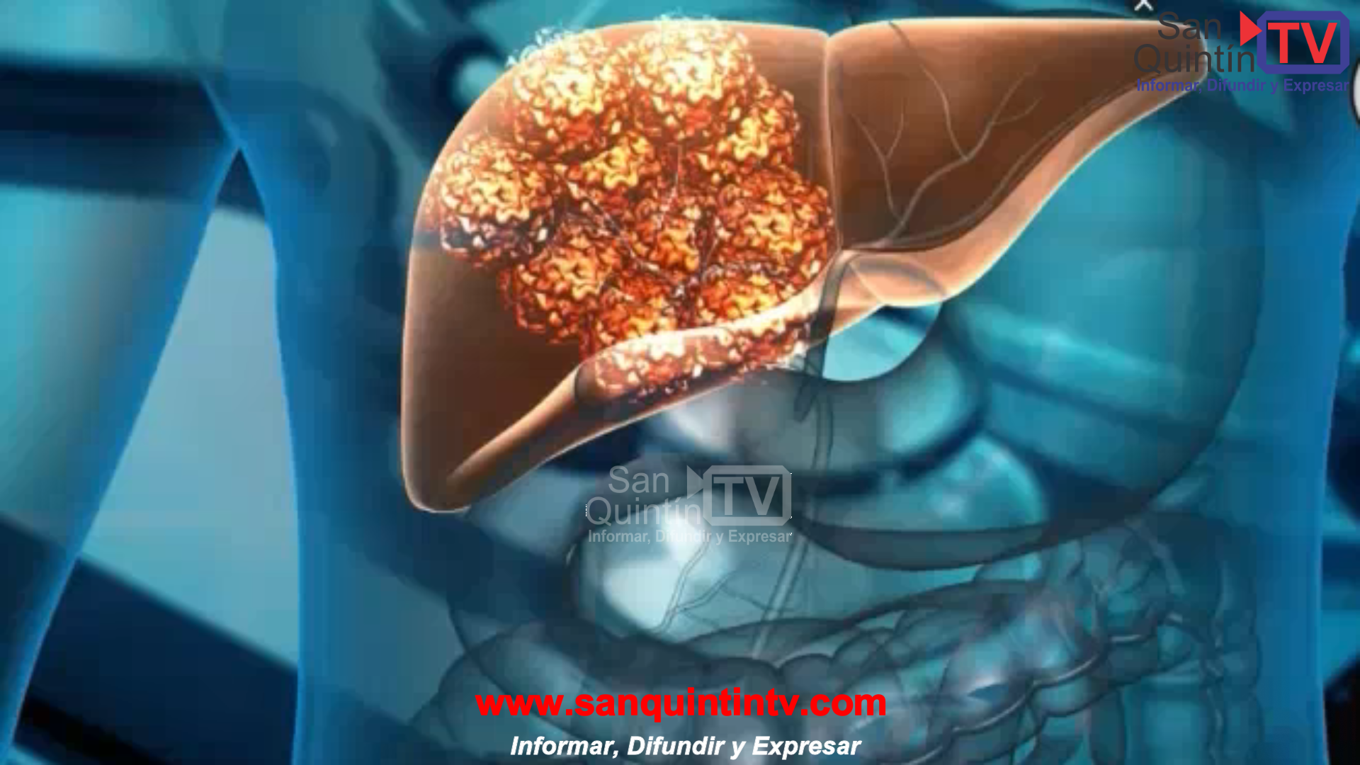 Refrescos bajo la lupa científica: el consumo frecuente aumenta el riesgo de desarrollar cáncer de hígado