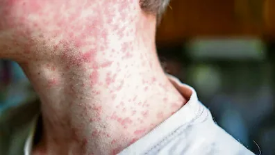 Sarampión cobra su primera víctima en CDMX y enciende alertas sanitarias